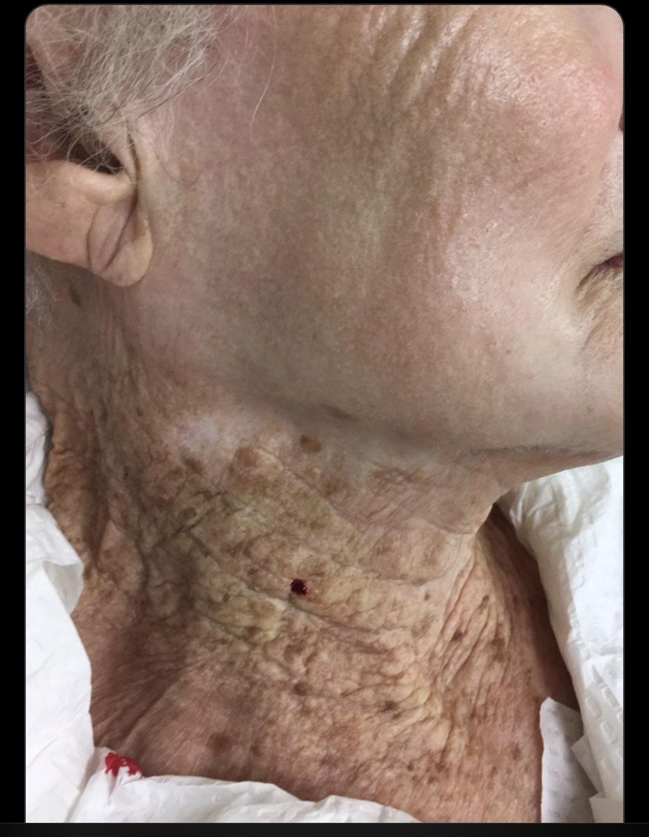 apply sunscreen to the neck for protection